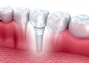 LDB_implantinplace