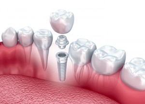 LDB_preparingforimplant