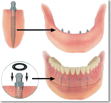 MDI_mini_implant.gif