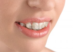 Teeth alignment. Braces. Beautiful woman smiling.