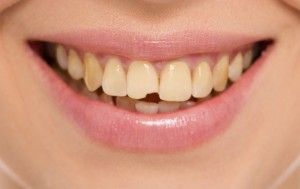 Teeth decay cure. Tooth whitening. Before and after.