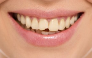 Teeth decay cure. Tooth whitening. Before and after.