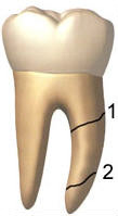 Oblique root fracture