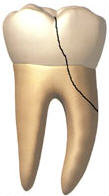 Split root fracture