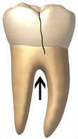 Vertical furcation fracture