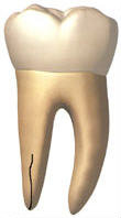 Vertical root fracture