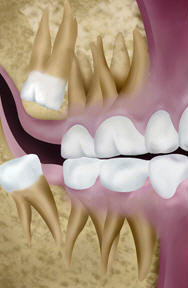 Distal impactions
