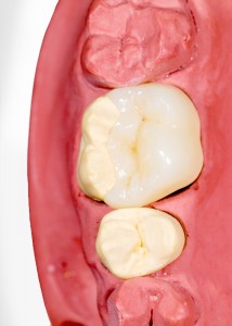 Ceramic molar onlay