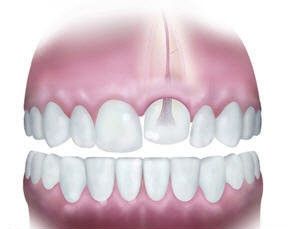 A tooth dislodged into its socket