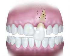 A tooth dislodged out of its socket