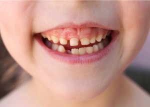 A collage of the child has lost the baby tooth.