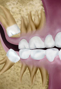 Mesial impactions
