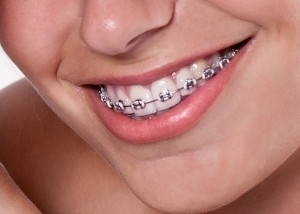 dental braces