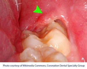 pericoronitis_b