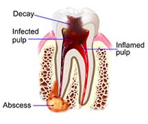 Decaying tooth