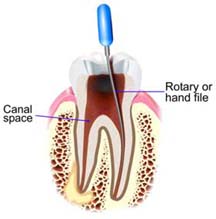 Root canal treatment