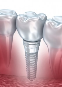 Tooth human implant, 3d illustration