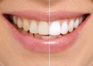 teeth whitening