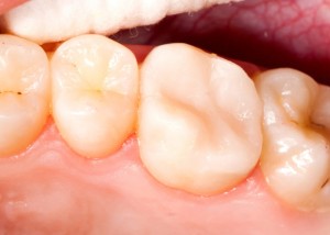 tooth restored