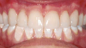 Porcelain Veneers Gallery Case 7 