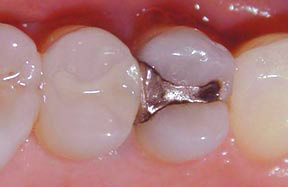 Fillings Gallery Case 8 Composite Inlay 