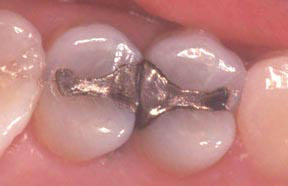 Fillings Gallery Case 8 Composite Inlay 