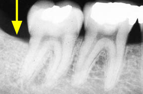 Periodontal Gallery - Bone Graft 