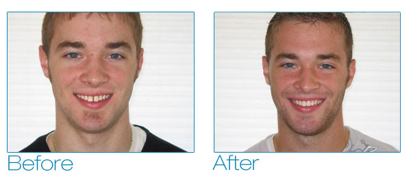 Brennan before and after #1