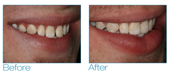 Brennan before and after #3