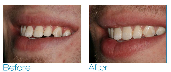Brennan before and after #4