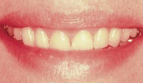Periodontal Gallery - Crown Lengthening Case 1 