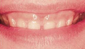 Periodontal Gallery - Crown Lengthening Case 1 