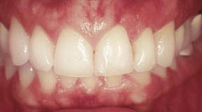 Periodontal Gallery - Crown Lengthening Case 2 
