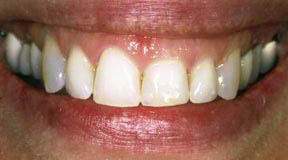 Periodontal Gallery - Crown Lengthening Case 2 