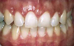 Periodontal Gallery 