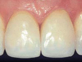 Crowns Gallery Case 5 