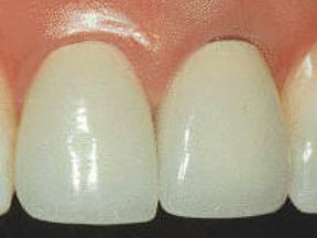 Crowns Gallery Case 5 