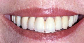 Crowns Gallery Case 6 
