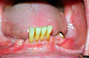 Dentures Gallery Case 4 