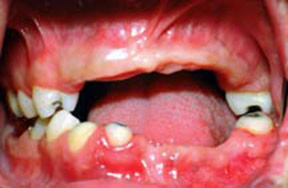Dentures Gallery Case 5 