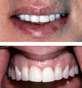 Dentures Gallery Case 1 