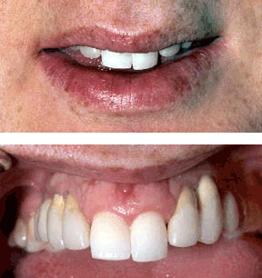 Dentures Gallery Case 1 