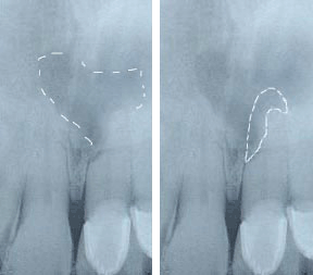 Root Canal Gallery Case 6 - External Resorption 