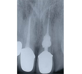Root Canal Gallery Case 8 - Internal Resorption 