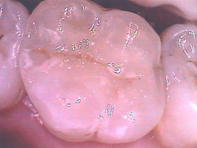 Fillings Case 2 Porcelain Inlay 