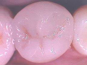 Fillings Case 3 Porcelain Onlay 