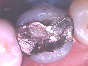 Fillings Case 3 Porcelain Onlay 