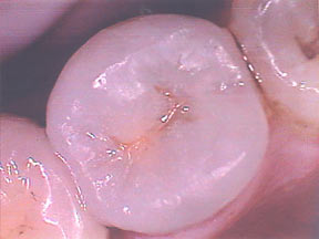Fillings Gallery Case 4 Porcelain Inlay 