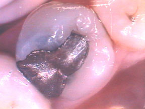 Fillings Gallery Case 4 Porcelain Inlay 