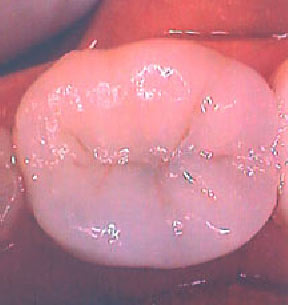 Fillings Gallery Case 5 Porcelain Onlay 